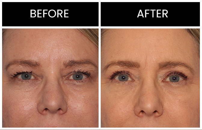 Eyelid Surgery Results Atlanta